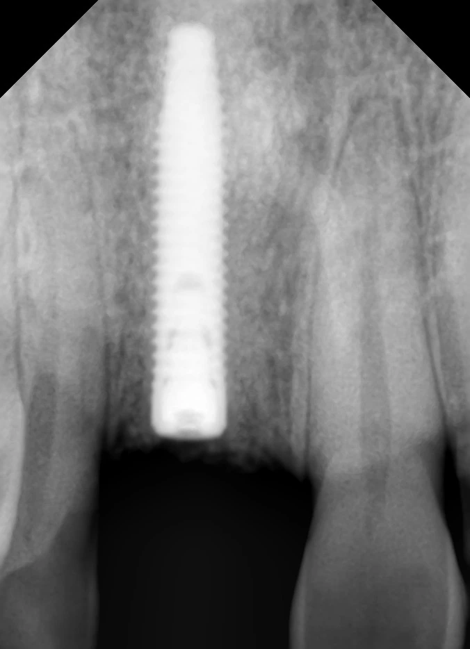 Radiograph confirming the dental implant fixture in the upper central incisor site at Smile Clinique, Mumbai
