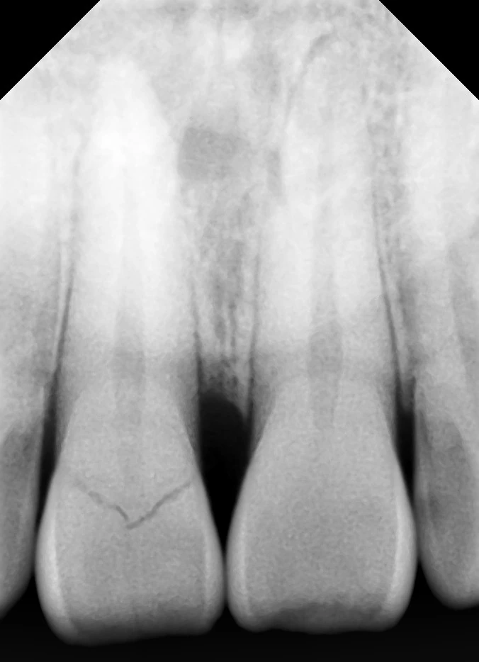 Pre-operative dental radiograph showing a missing upper central incisor at Smile Clinique, Malabar Hill, Mumbai