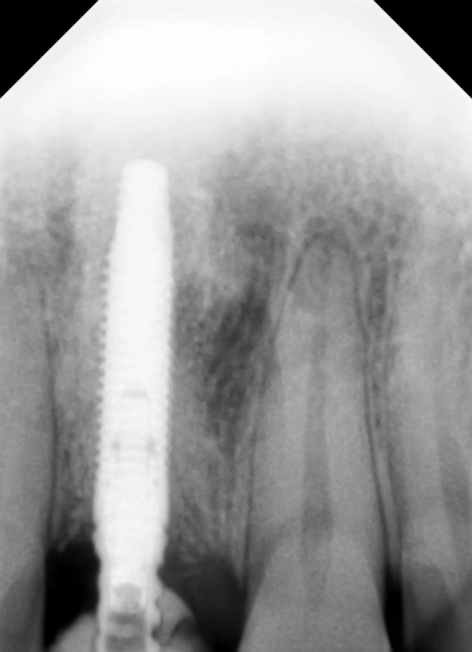 Radiograph of an implant-supported restoration at Smile Clinique in Malabar Hill, Mumbai