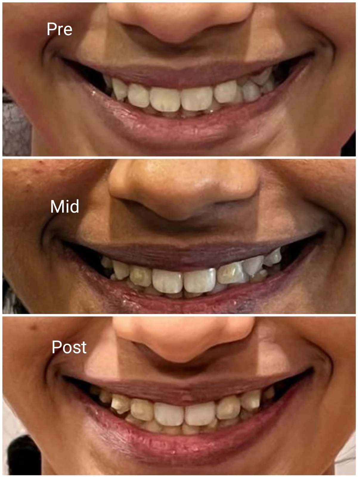 Frontal pre, mid and post clear aligner treatment views at Smile Clinique in Malabar Hill, Mumbai