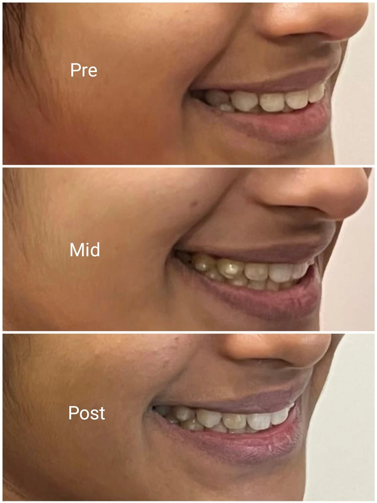 Profile pre, mid and post clear aligner smile views at Smile Clinique, Malabar Hill, Mumbai